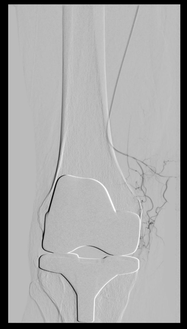Siegburg: Joint embolization - new therapy for painful knee prostheses