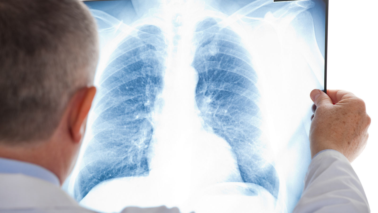 Lung cancer treatment: Modern methods and treatment options